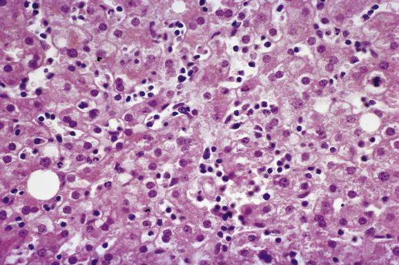 Fig. 15.6, Infectious mononucleosis.