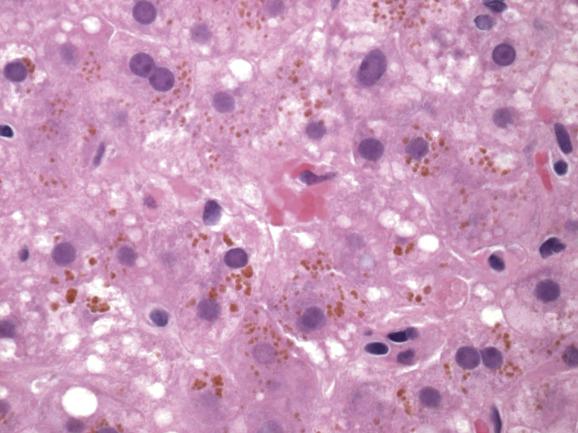 Fig. 15.7, Hepatocellular pigment associated with antiretroviral therapy for HIV.