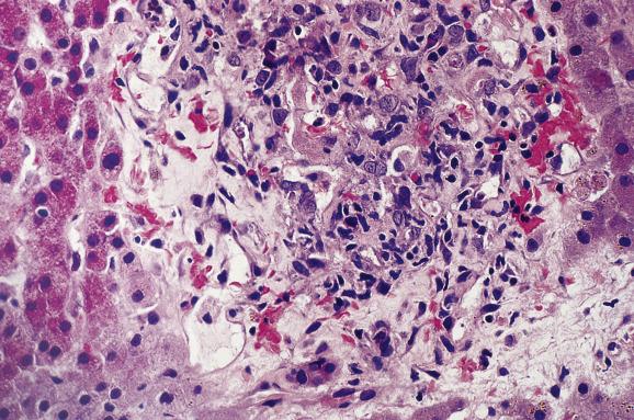 Fig. 15.9, Bacillary peliosis in AIDS.