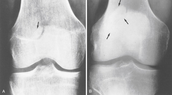 FIGURE 7-208, A, The smaller element of a bipartite patella is usually smaller than the fossa in the major portion. B, Occasionally, however, it is larger than the fossa.