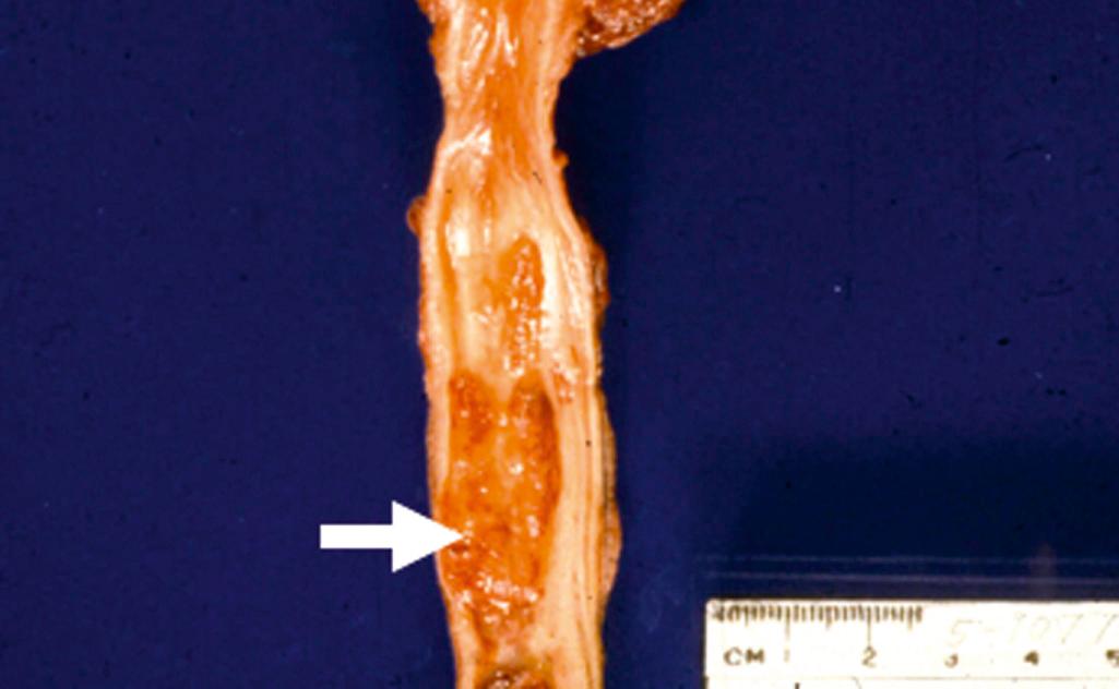 Figure 21.11, Carcinoma of urethra with typical fungating growth pattern (arrow).