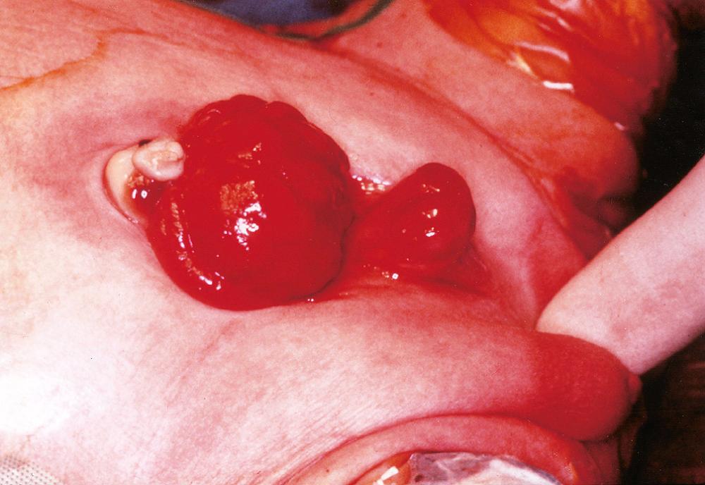 Figure 21.2, Exstrophy of the bladder in a newborn boy. The tied umbilical cord is seen above the hyperemic mucosa of the everted bladder. Below is an incompletely formed penis with marked epispadias.