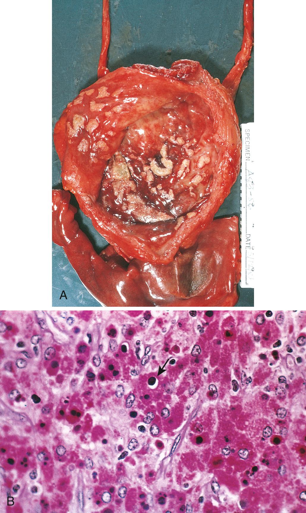 Figure 21.3, Malakoplakia. (A) Bladder involved by malakoplakia showing the characteristic yellow-orange mucosal lesions. (B) Periodic acid–Schiff (PAS) stain. Note the large macrophages with granular PAS-positive cytoplasm and several dense, round Michaelis-Gutmann bodies surrounded by artifactual cleared holes in the upper middle field (arrow).