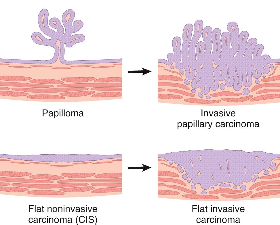 Figure 21.4, Four morphologic patterns of bladder tumors. CIS, Carcinoma in situ.