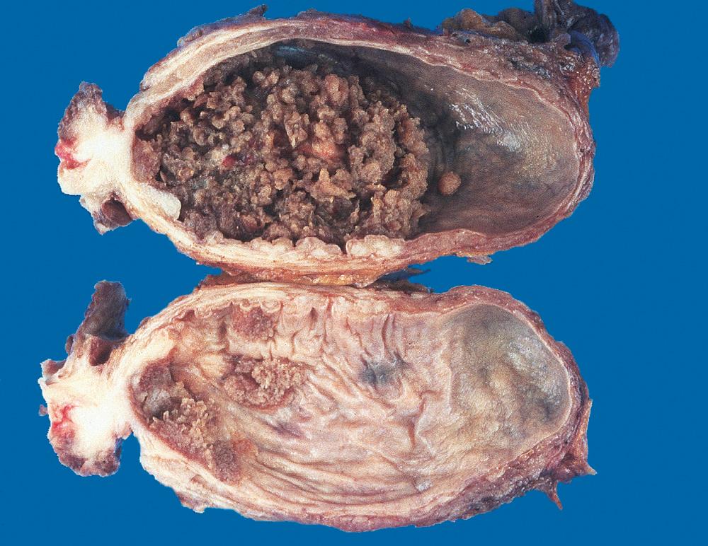 Figure 21.6, Cross-section of bladder with the upper section showing a large papillary tumor. The lower section demonstrates multifocal smaller papillary neoplasms.
