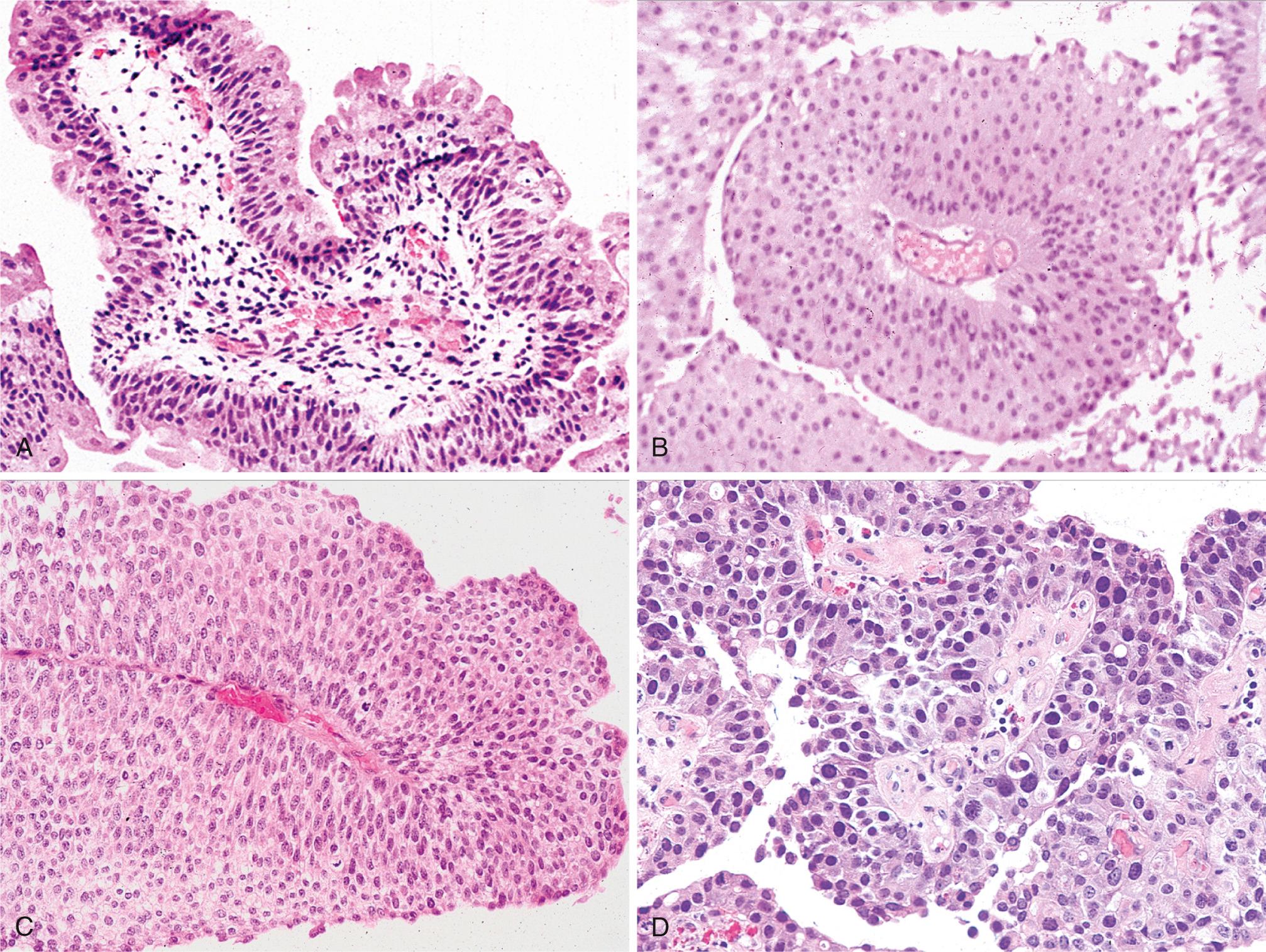 Figure 21.7, Papillary urothelial neoplasms. (A) Papilloma consisting of small papillary fronds lined by normal-appearing urothelium. (B) Papillary urothelial neoplasms of low malignant potential (PUNLMP) showing thicker urothelium with greater density of cells. (C) Low-grade papillary urothelial carcinoma with an overall orderly appearance, with scattered hyperchromatic nuclei and mitotic figures (upper left). (D) High-grade papillary urothelial carcinoma with marked cytologic atypia.