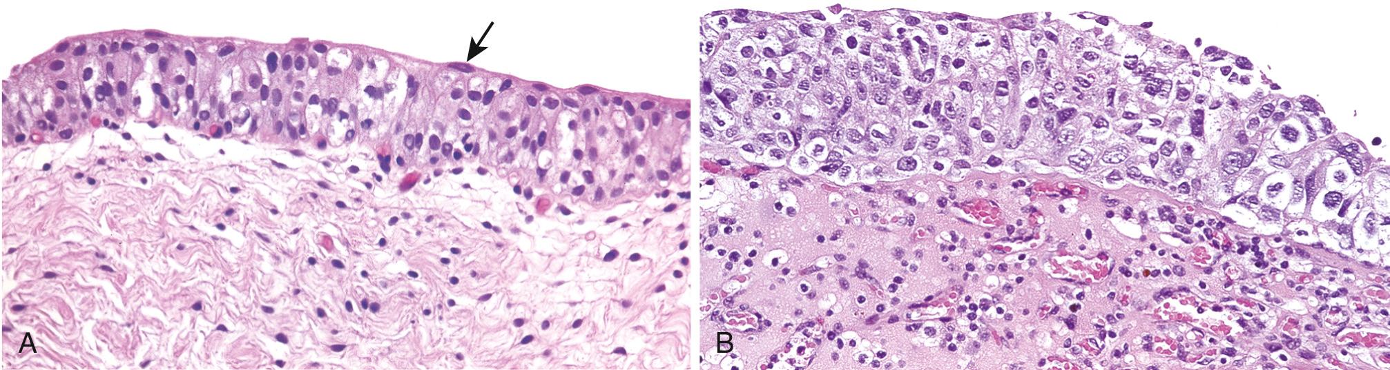 Figure 21.8, Bladder carcinoma in situ. (A) Normal urothelium with uniform nuclei and well-developed umbrella cell layer. (B) Carcinoma in situ showing a disorganized urothelium containing numerous cells having markedly enlarged and pleomorphic nuclei.