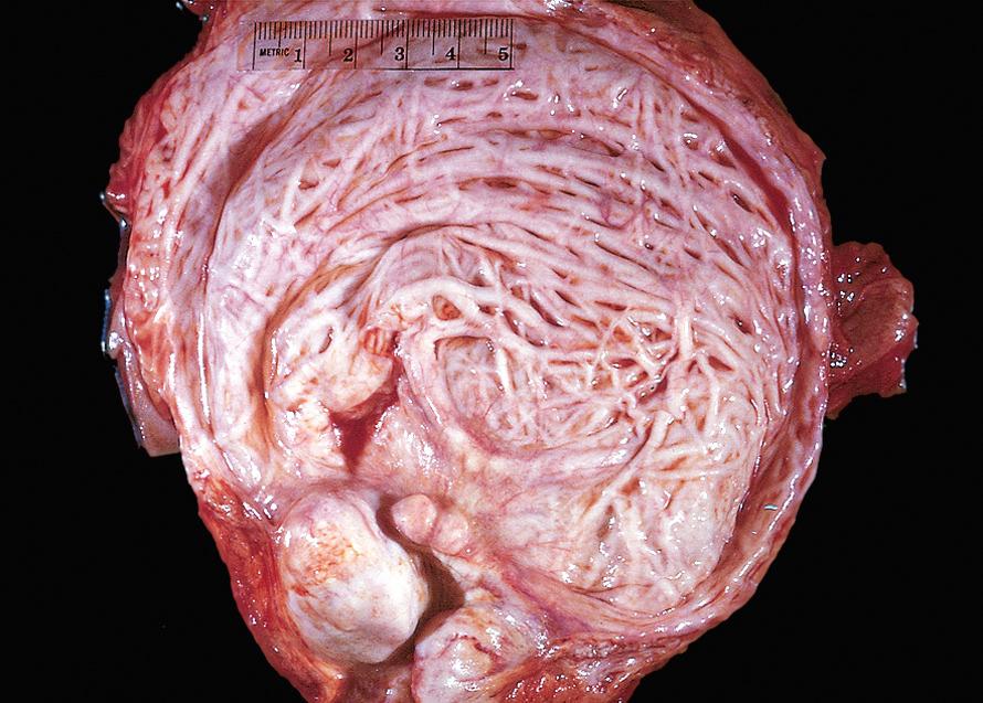 Figure 21.10, Hypertrophy and trabeculation of bladder wall secondary to benign prostatic hyperplasia.