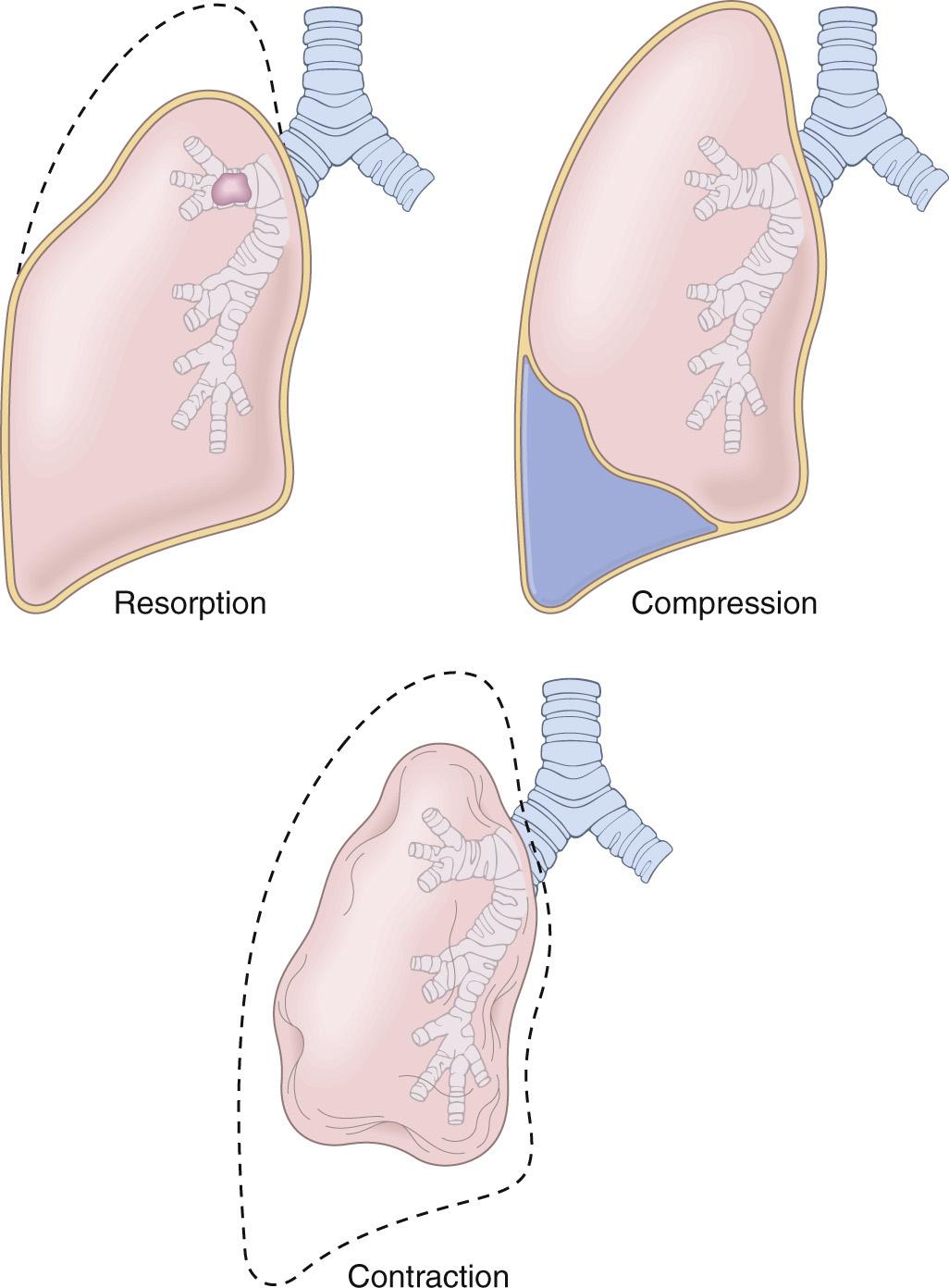 Figure 15.2, Various forms of acquired atelectasis. Dashed lines indicate normal lung volume.