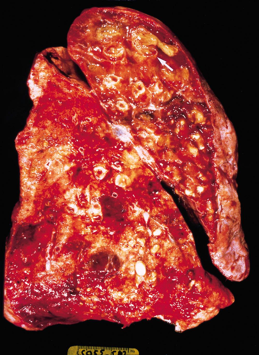 Figure 15.12, Bronchiectasis in a patient with cystic fibrosis, who underwent lung transplantation. Cut surface of lung shows markedly distended peripheral bronchi filled with mucopurulent secretions.