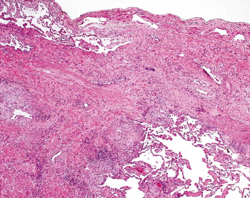 Figure 15.14, Usual interstitial pneumonia. The fibrosis is more pronounced in the subpleural region.