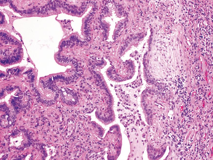 Figure 15.15, Usual interstitial pneumonia. Fibroblastic focus with fibers running parallel to surface and bluish myxoid extracellular matrix. Honeycombing is present on the left.