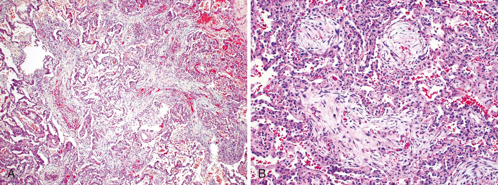 Figure 15.16, Cryptogenic organizing pneumonia. Some alveolar spaces are filled with balls of fibroblasts (Masson bodies), while the alveolar walls are relatively normal. (A) Low power. (B) High power.