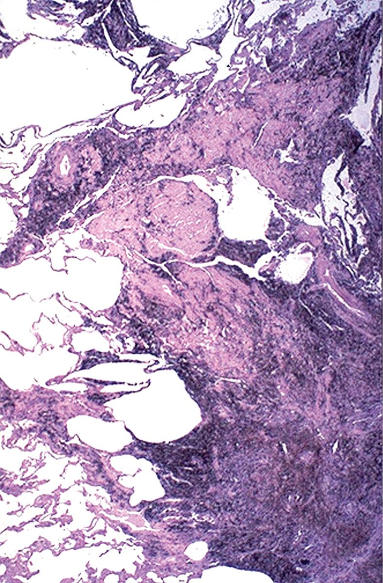 Figure 15.17, Progressive massive fibrosis in a coal worker. A large amount of black pigment is associated with dense interstitial fibrosis.