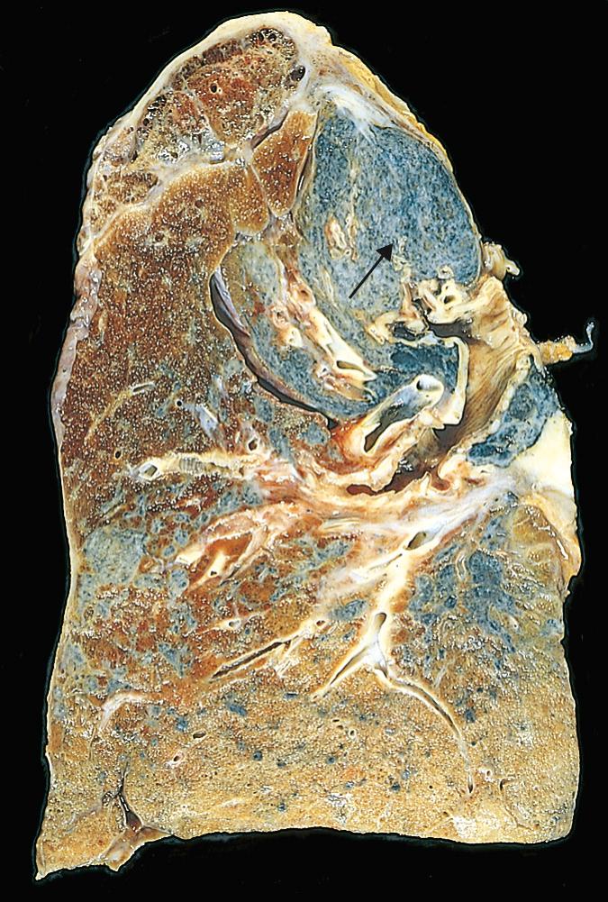 Figure 15.18, Advanced silicosis. Scarring has contracted the upper lobe into a small dark mass (arrow) . Note the dense pleural thickening.