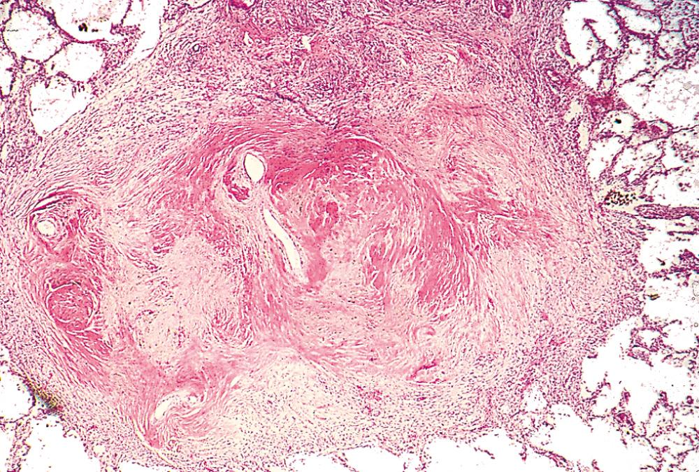 Figure 15.19, Several coalescent collagenous silicotic nodules.