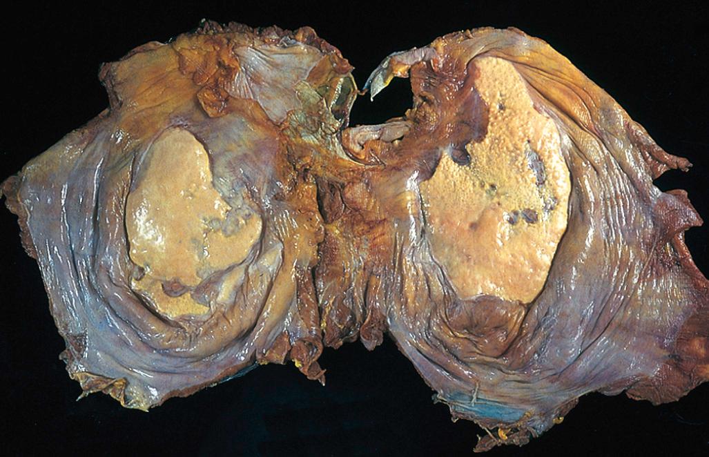 Figure 15.21, Asbestos-related pleural plaques. Large, discrete fibrocalcific plaques are seen on the pleural surface of the diaphragm.