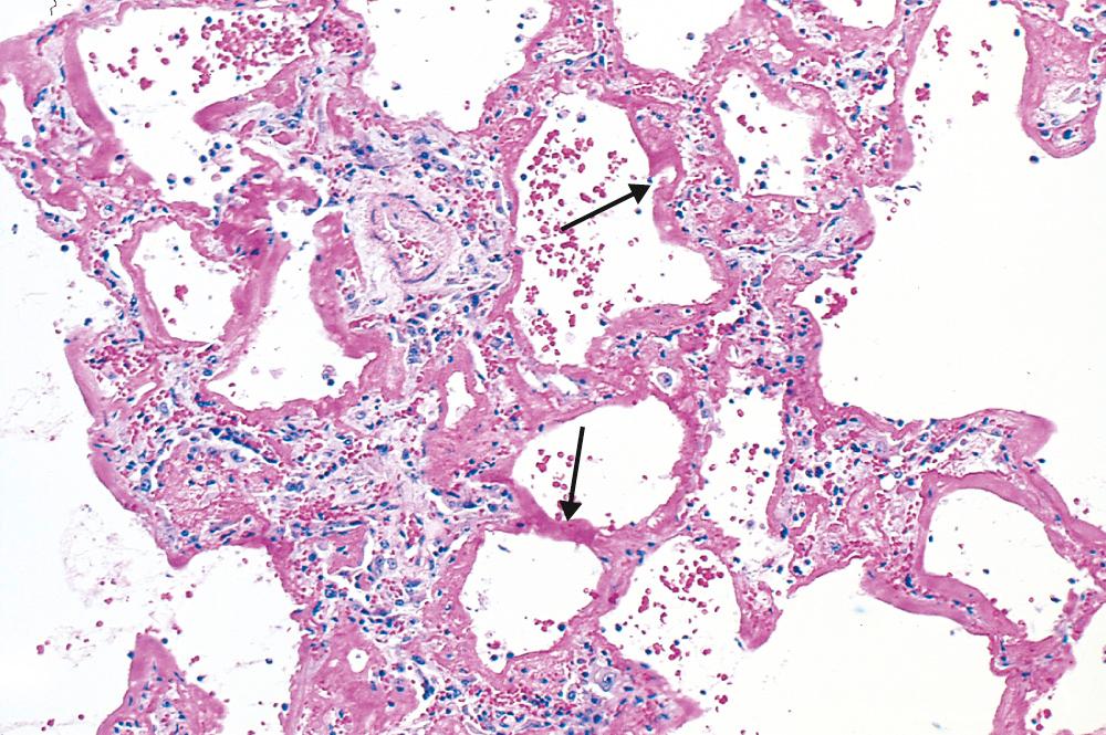 Figure 15.4, Diffuse alveolar damage (acute respiratory distress syndrome). Some of the alveoli are collapsed, while others are distended. Many are lined by hyaline membranes (arrows) .