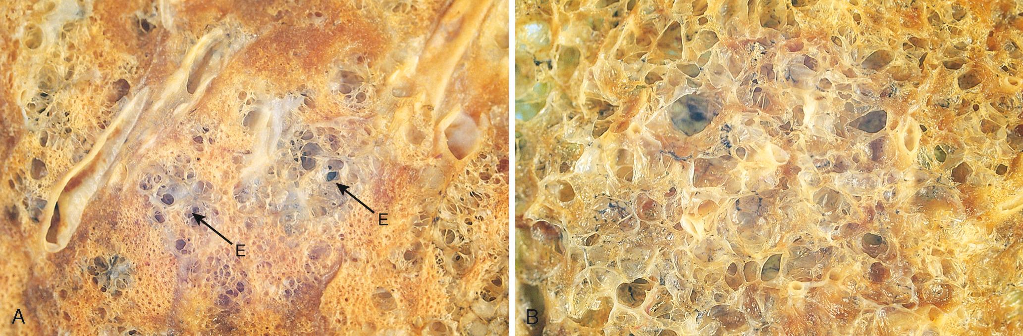 Figure 15.7, (A) Centriacinar emphysema. Central areas show marked emphysematous damage (E) surrounded by relatively spared alveolar spaces. (B) Panacinar emphysema involving the entire pulmonary lobule.