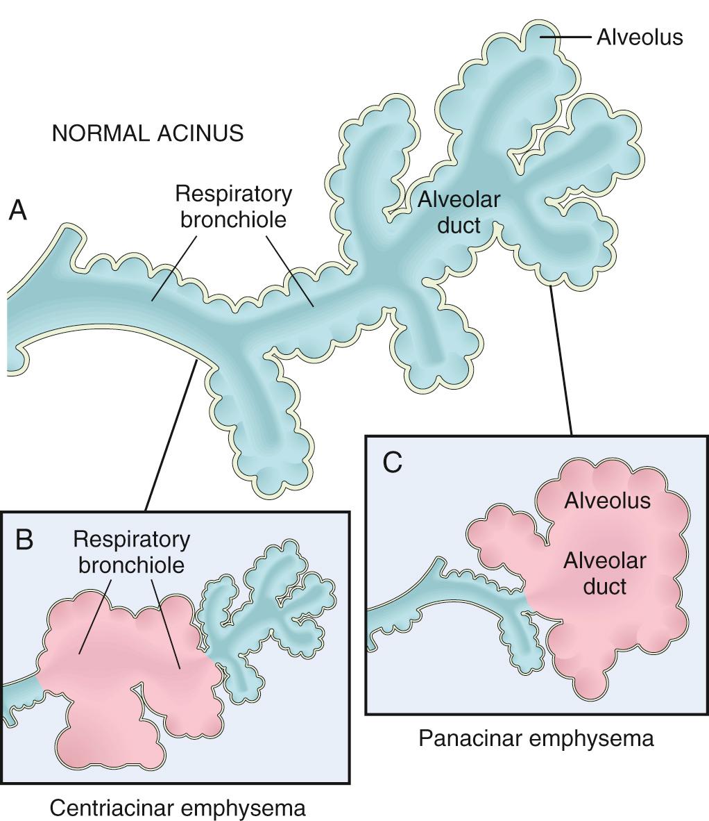 Figure 15.6, Clinically significant patterns of emphysema. (A) Structure of the normal acinus. (B) Centriacinar emphysema with dilation that initially affects the respiratory bronchioles. (C) Panacinar emphysema with initial distention of the alveolus and alveolar duct.