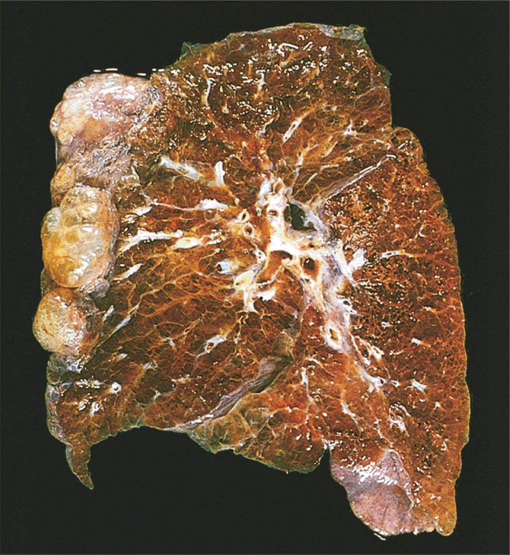 Figure 15.9, Bullous emphysema. Note the large subpleural bullae (upper left) .