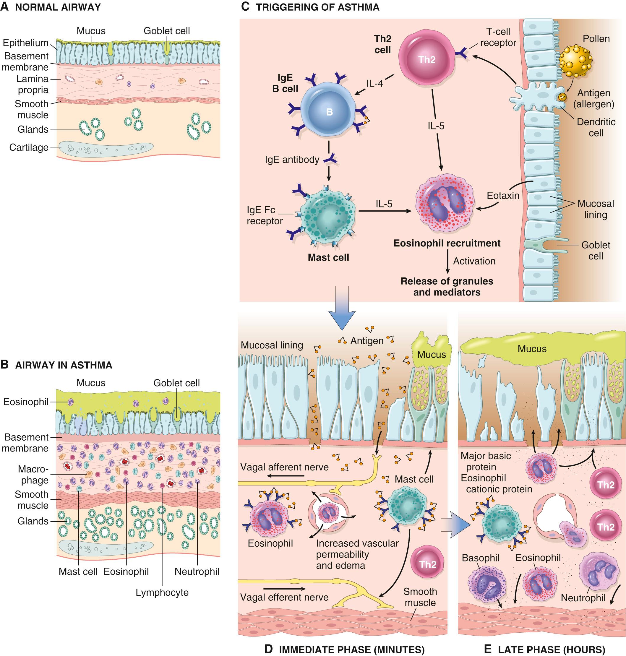 Figure 15.10, (A and B) Comparison of a normal airway and an airway involved by asthma. The asthmatic airway is marked by accumulation of mucus in the bronchial lumen secondary to an increase in the number of mucus-secreting goblet cells in the mucosa and hypertrophy of submucosal glands; intense chronic inflammation due to recruitment of eosinophils, macrophages, and other inflammatory cells; thickened basement membrane; and hypertrophy and hyperplasia of smooth muscle cells. (C) Inhaled allergens (antigen) elicit a Th2-dominated response favoring IgE production and eosinophil recruitment. (D) On re-exposure to antigen, the immediate reaction is triggered by antigen-induced cross-linking of IgE bound to Fc receptors on mast cells. These cells release preformed mediators that directly and via neuronal reflexes induce bronchospasm, increased vascular permeability, mucus production, and recruitment of leukocytes. (E) Leukocytes recruited to the site of reaction (neutrophils, eosinophils, and basophils; lymphocytes and monocytes) release additional mediators that initiate the late phase reaction. Several factors released from eosinophils (e.g., major basic protein, eosinophil cationic protein) also cause damage to the epithelium. IL-5, Interleukin-5.