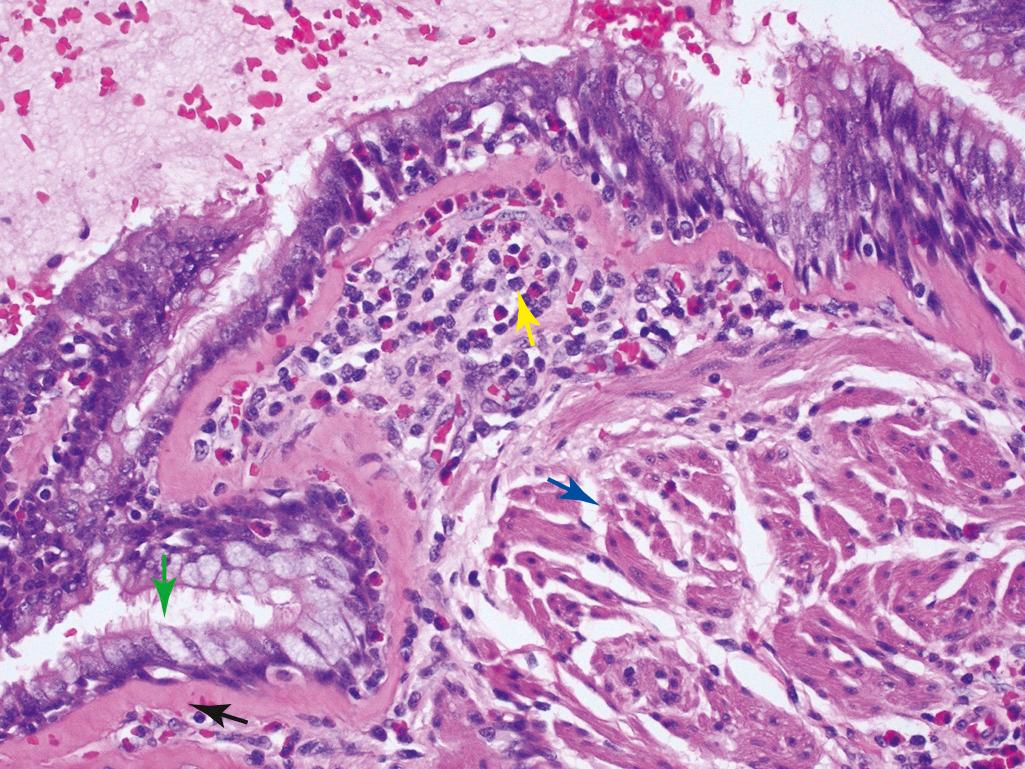 Figure 15.11, Bronchus from an asthmatic patient showing goblet cell hyperplasia (green arrow) , sub–basement membrane fibrosis (black arrow), eosinophilic inflammation (yellow arrow), and muscle hypertrophy (blue arrow).