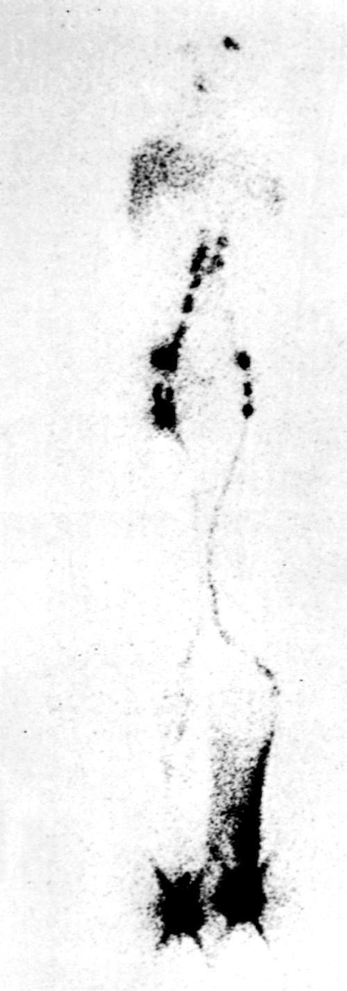 Fig. 66.3, Lymphoscintigraphic pattern in primary lymphedema. Note area of dermal backflow on the left and diminished number of lymph nodes in the groin.