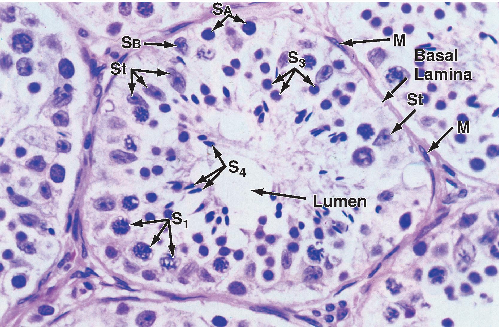 Fig. 44.4, Histology of a seminiferous tubule. M , Myoid cell just outside the basal lamina; S 1 , primary spermatocyte; S 3 , spermatid; S 4 , mature spermatid or spermatozoon; S B and S A , spermatogonia; St , Sertoli cell.