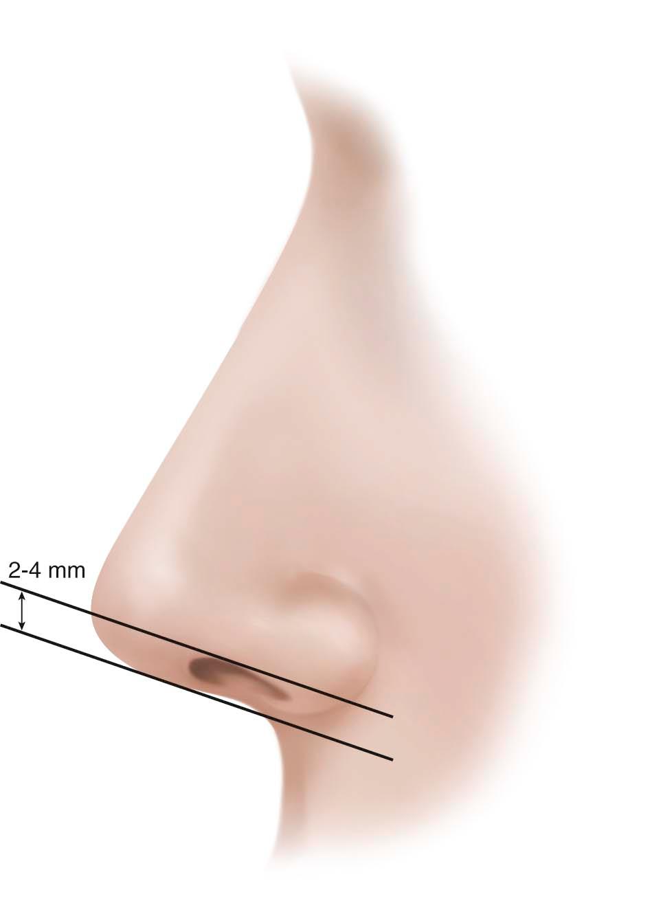 Figure 21-1, Normal columellar show is defined as 2 to 4 mm.