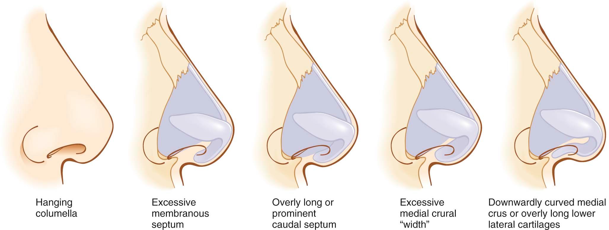 Figure 21-3, The hanging columella deformity can be the result of excess membranous septum, prominent caudal septum, excessively wide medial and intermediate crus, downwardly curved medial crus, or overly long lower lateral cartilages (LLCs).