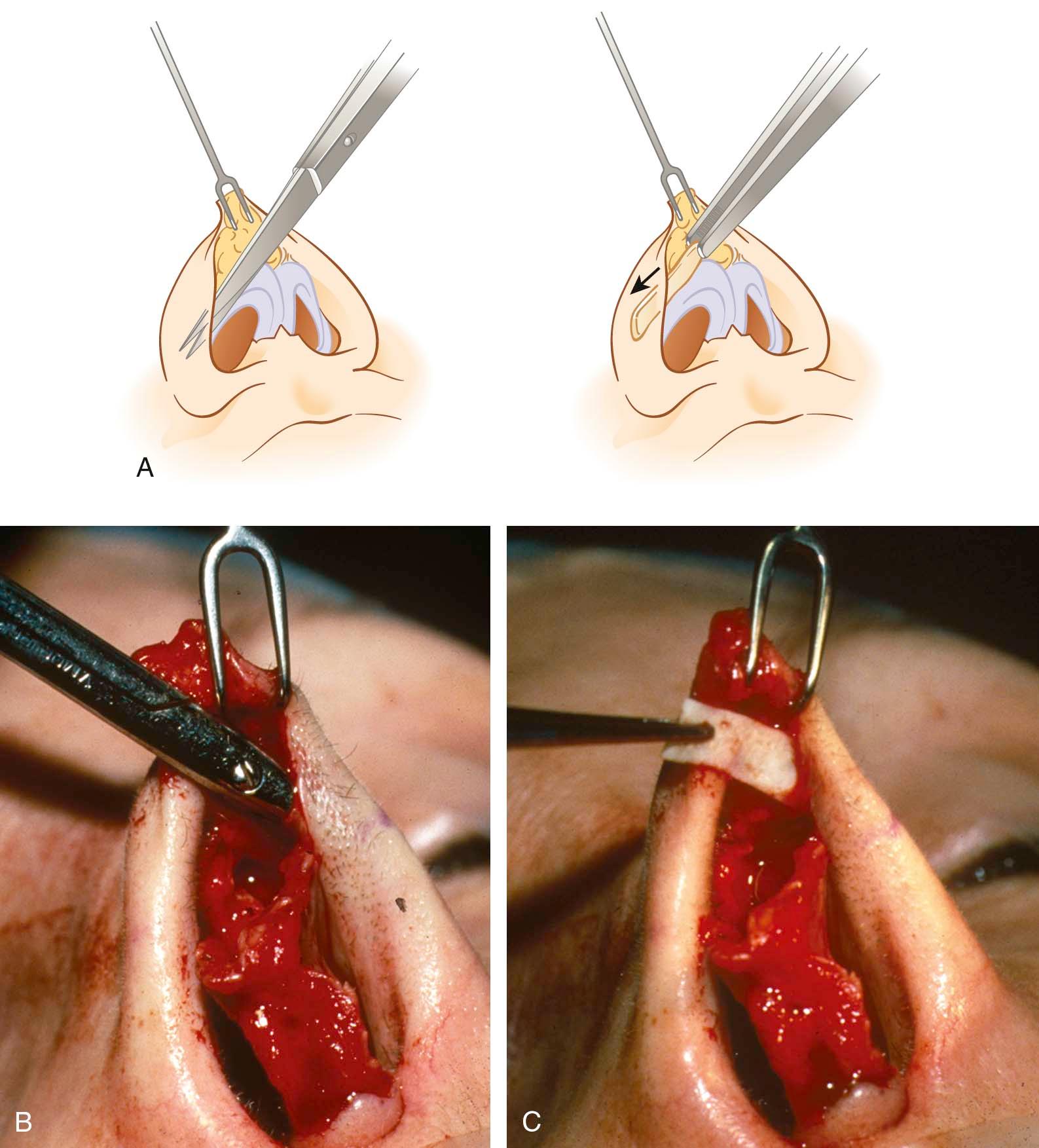 Figure 21-5, A, Schematic showing the technique of placing an alar rim graft via an open rhinoplasty approach. B, C, Actual intraoperative views showing the technique of placing an alar rim graft via an open rhinoplasty approach.