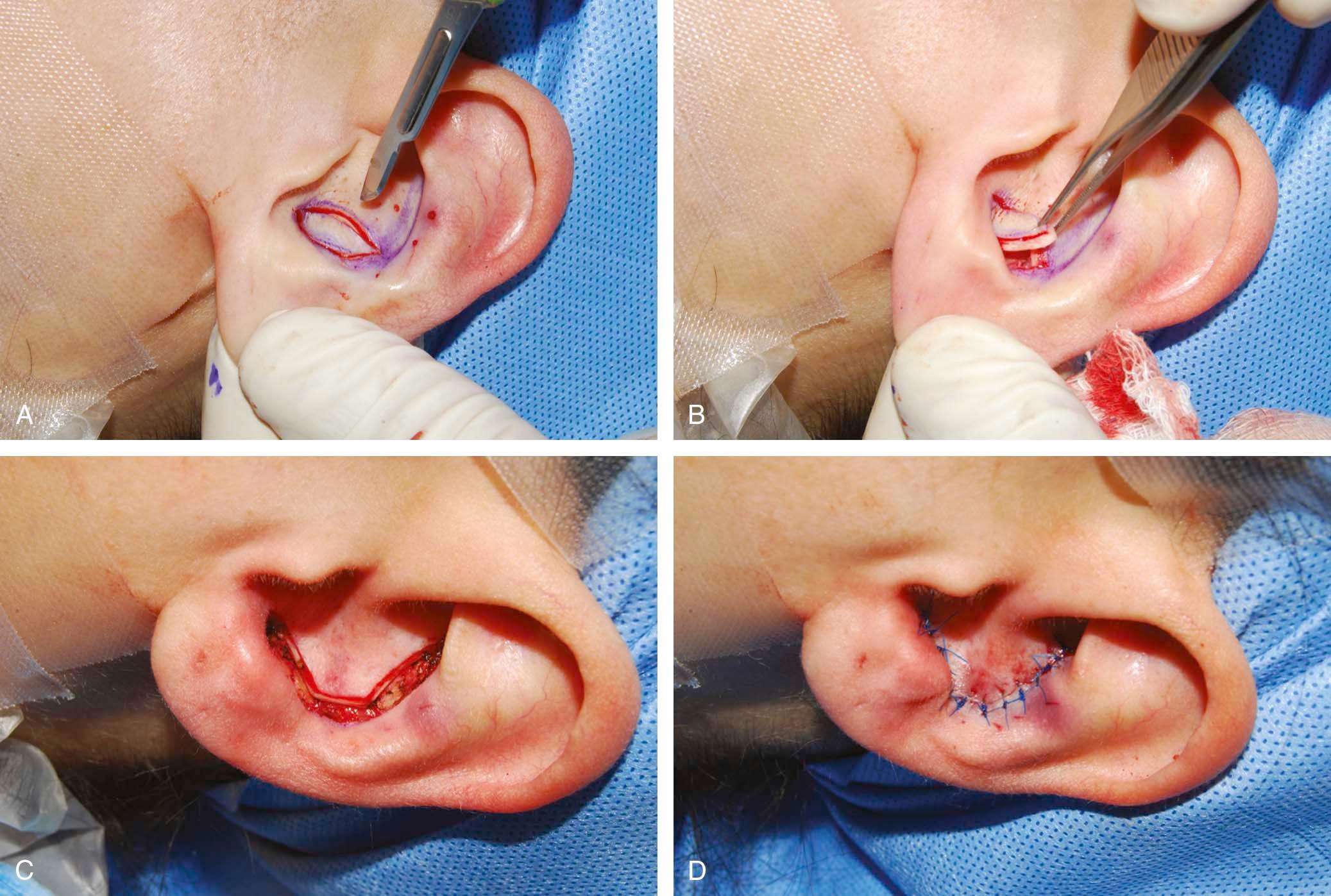 Figure 21-6, A, Harvest of free auricular composite grafts from both the concha cymba and concha cava. B, Conchal cartilage is taken with anterior conchal skin. C, The harvest leaves a symmetric defect. D, Closure is possible without auricular deformity.