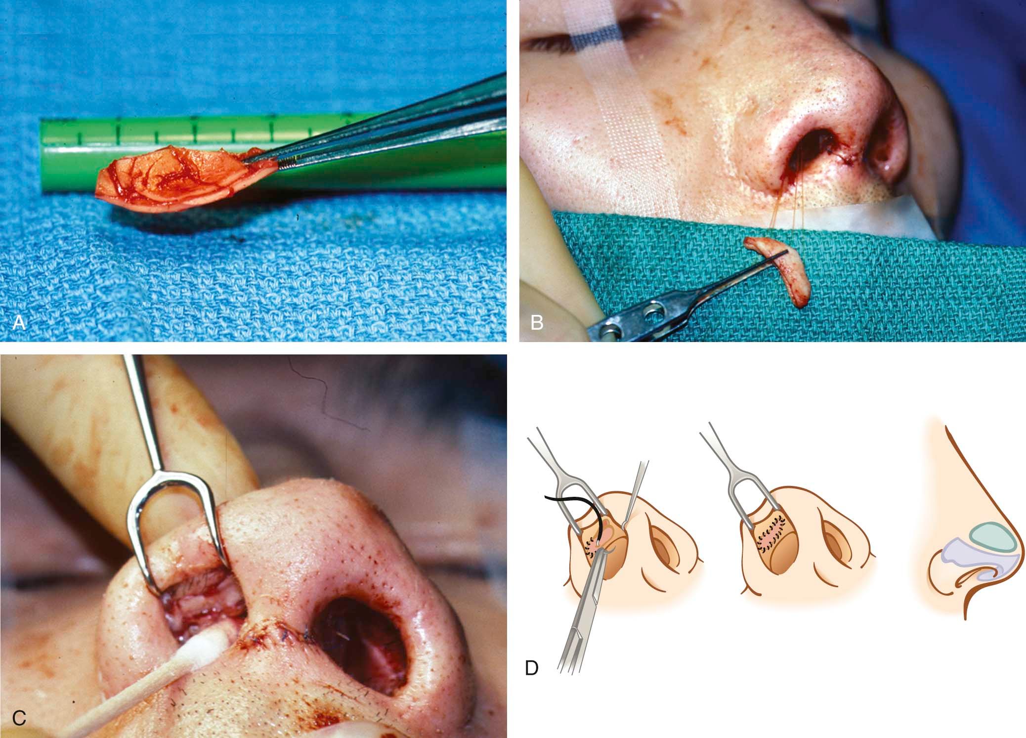 Figure 21-7, A composite cartilage graft can be placed in the scroll area to “push” the alar rim inferiorly.