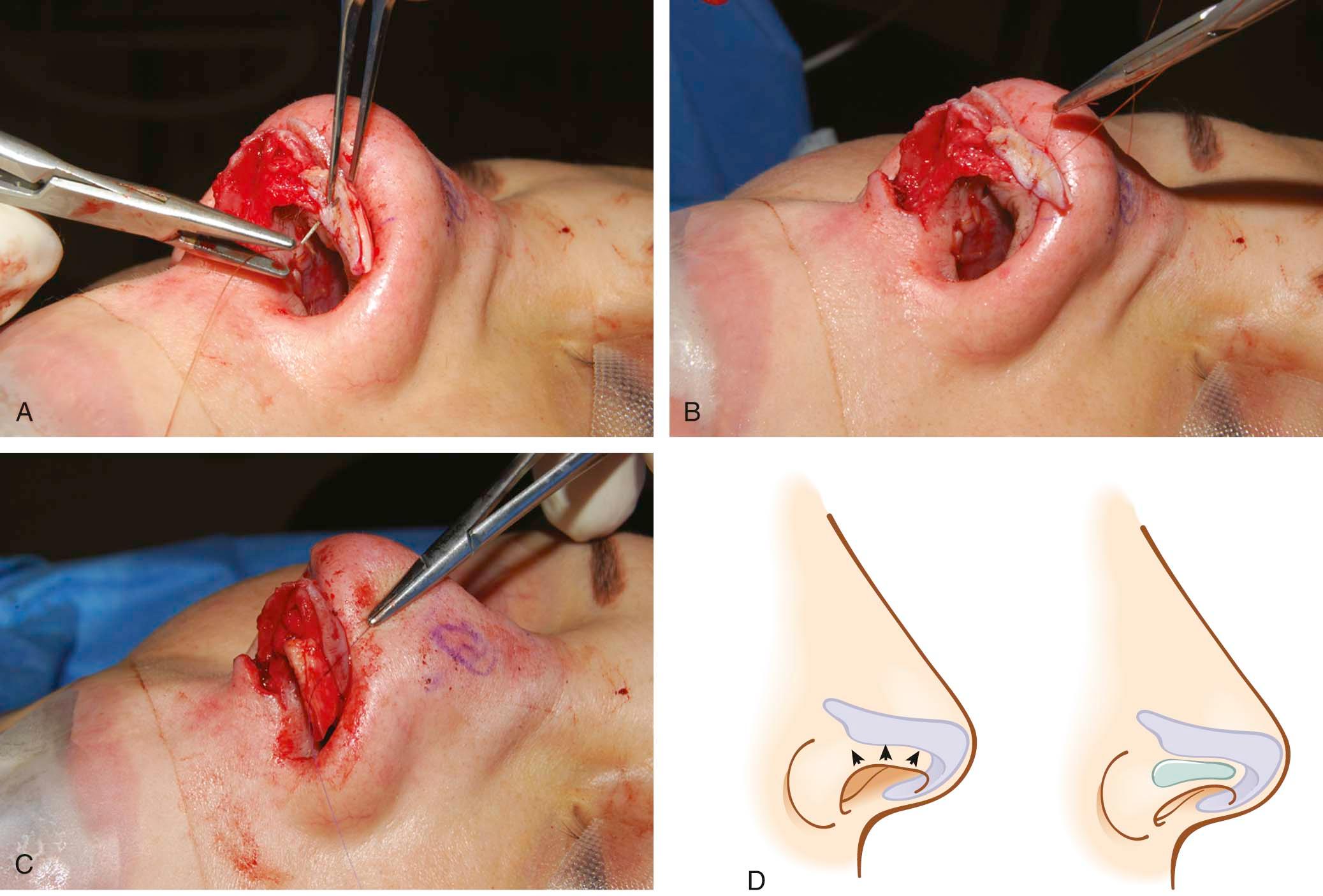 Figure 21-8, A composite auricular cartilage graft is placed on the caudal edge of the lower lateral cartilage to treat the retracted/notched ala.