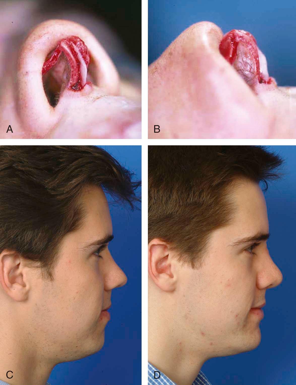 Figure 21-9, A, B, Intraoperative photographs showing that the columellar strut can be fashioned to extend caudally beyond the caudal border of the medial crura to treat the retracted columella. C, Preoperative photograph of the same patient, showing a retracted columella. D, Postoperative photograph of the same patient, showing an improved alar–columellar relationship.