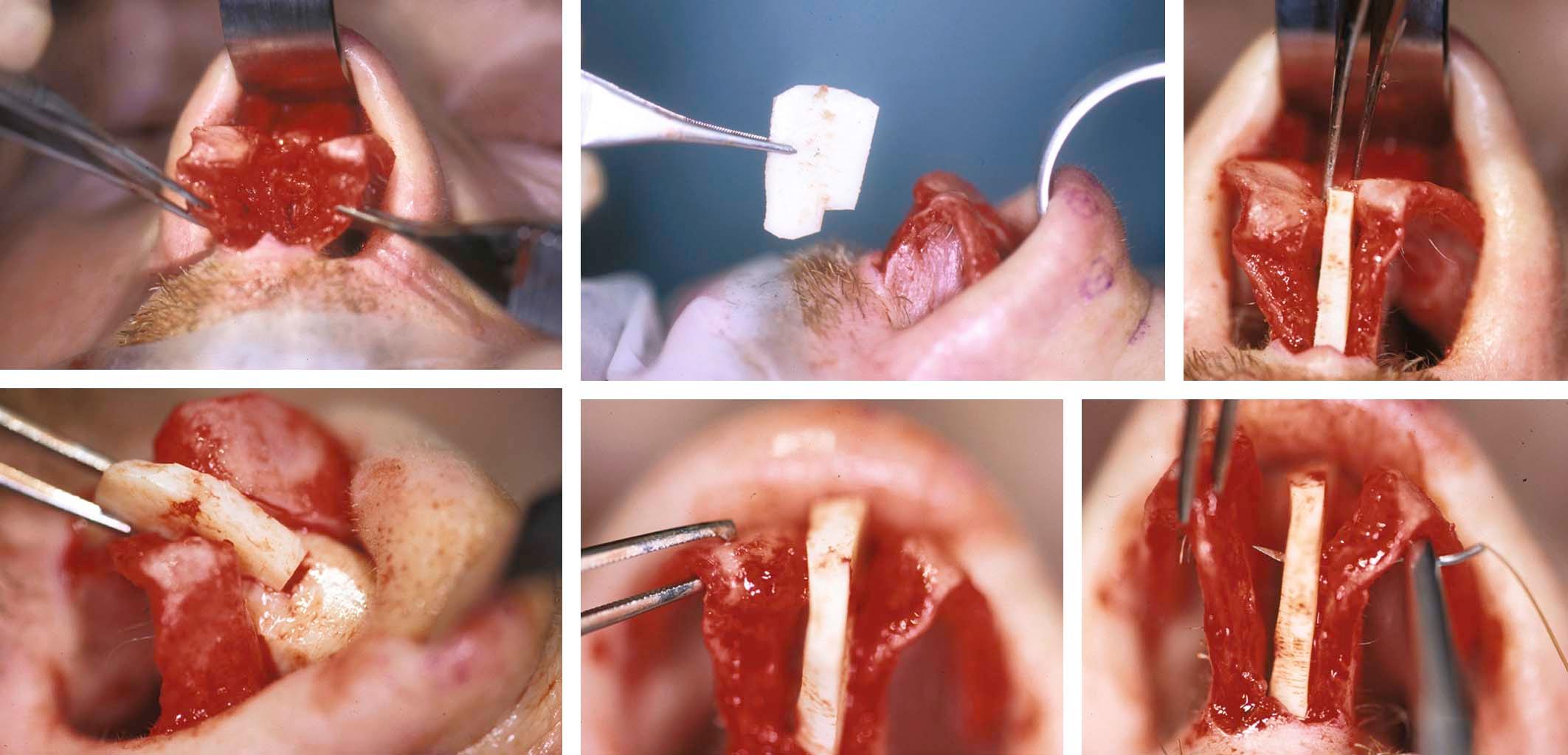 Figure 21-10, In cases where the caudal septum is weak or missing, a septal extension graft or a caudal septal replacement graft can help improve tip support and correct the retracted columella (intraoperative view).