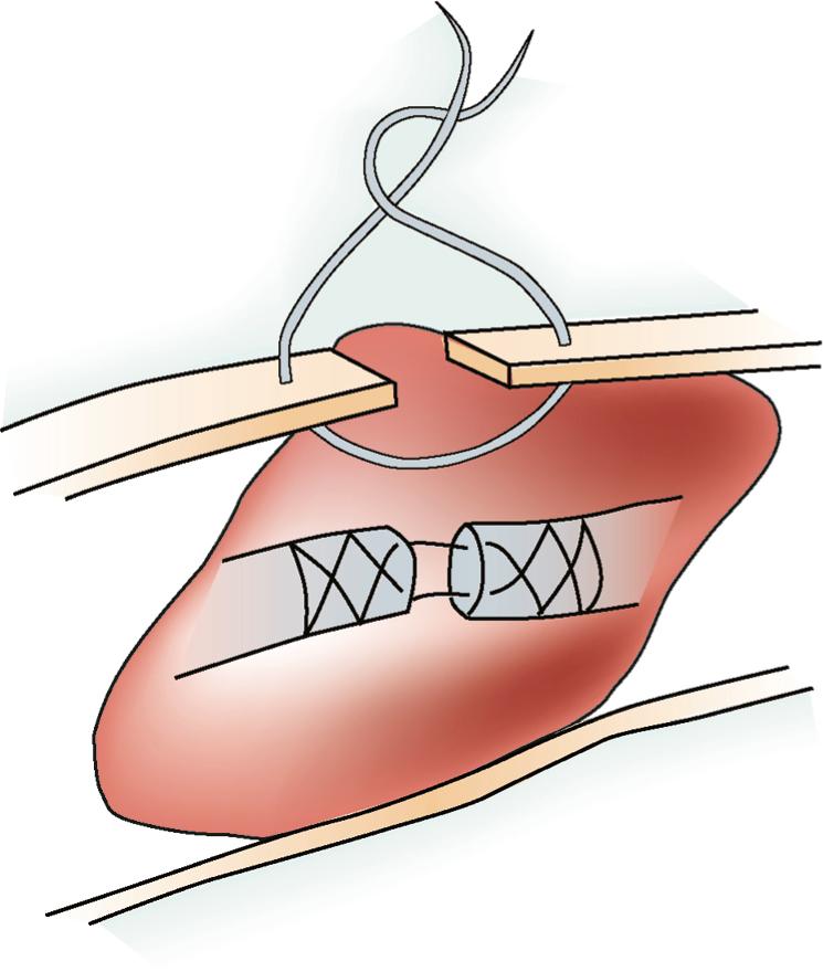 Fig. 43.2, Classic figure depicting the “one wound–one scar” concept described by Peacock. Despite the best attempts at reconstruction, a scar will form from the skin down to bone and compromise the function of all structures in between and the extremity overall.