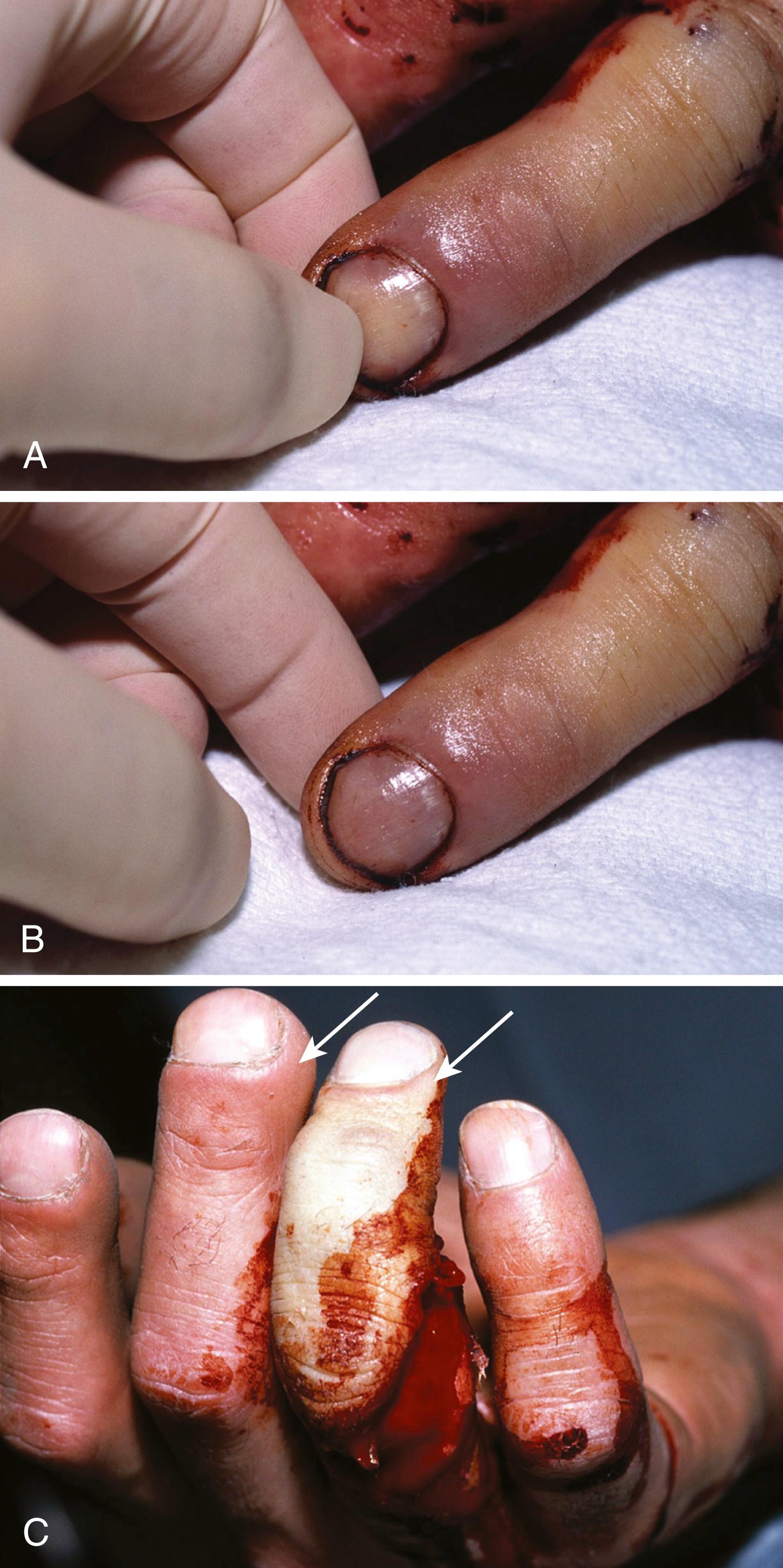 Fig. 43.3, A completely devascularized digit can have what appears to be intact capillary refill beneath the nail bed when in fact stagnant blood is merely being pushed to the sides with compression (A) and then moves back to the center with release of pressure on the nail bed (B) . A far more reliable area to assess digit perfusion is the dorsal paronychial tissue on the sides of the nail, which should be pink and spongy and have good turgor, compressing with pressure and refilling with release (long finger, arrow ), whereas a devascularized digit’s paronychial tissue (C) will be pale and flat, without turgor (ring finger, arrow ).