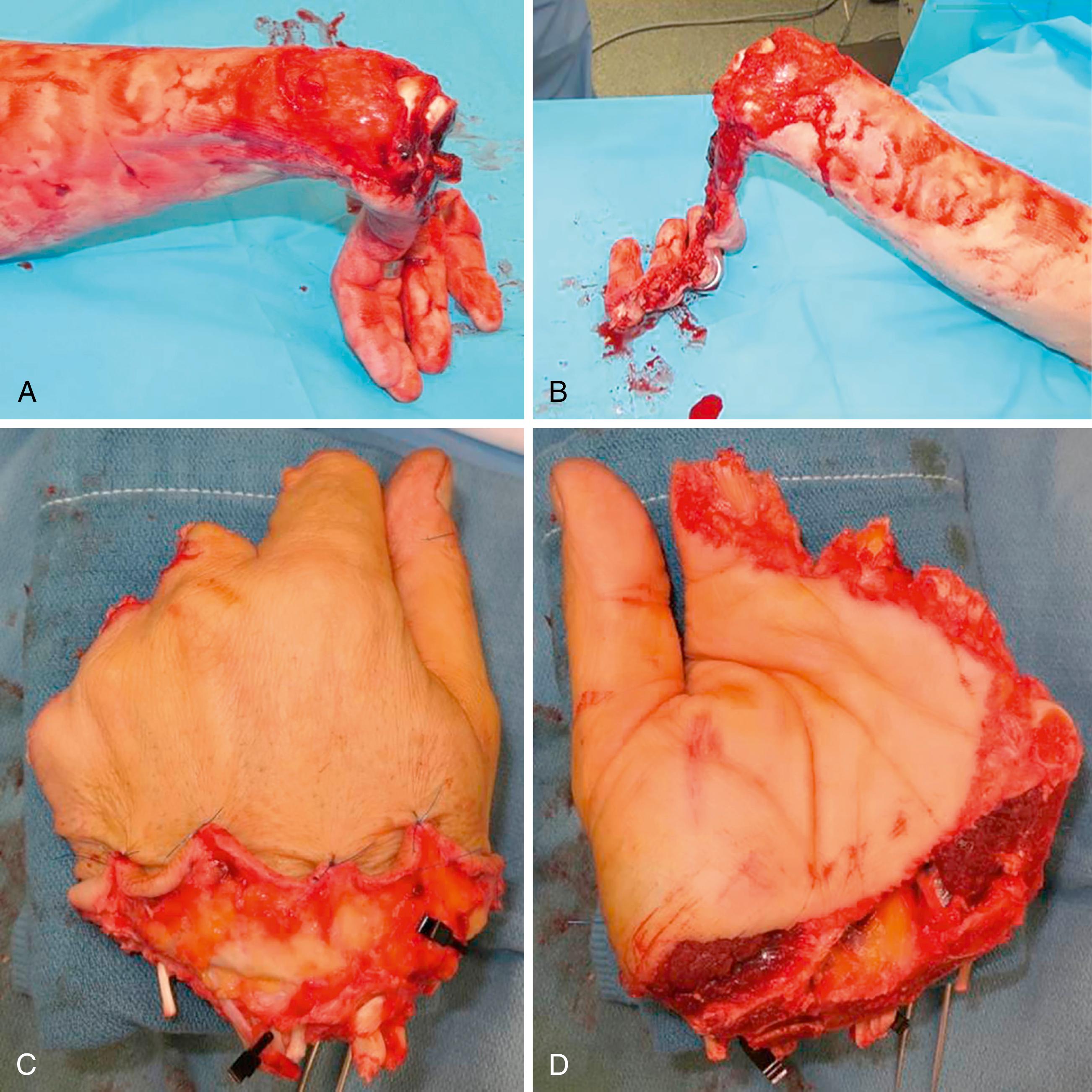 eFig. 43.1, A to D, Amputation injury.