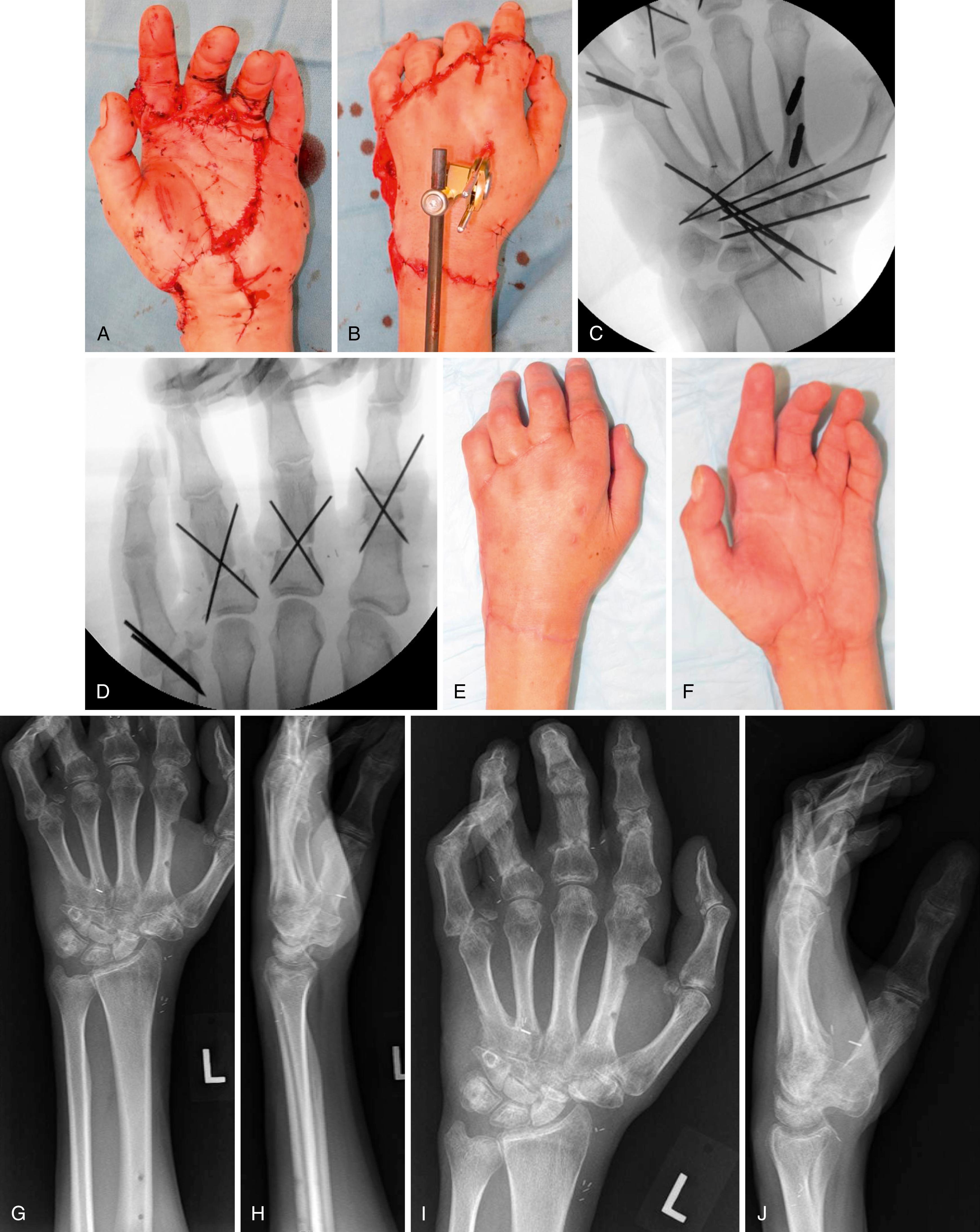 eFig. 43.2, A and B, Clinical photos immediately following replantation. C and D, Immediate postoperative radiographs. E and F, Clinical photos following hardware removal. G to J, Radiographs following hardware removal.