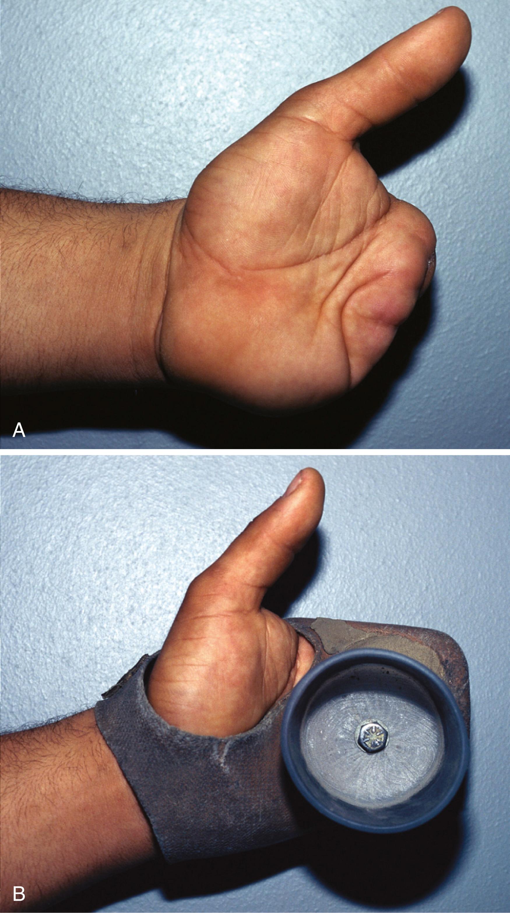 Fig. 43.6, A and B, Sometimes a prosthesis customized to the patient’s occupation is the best option, as for this forklift driver.