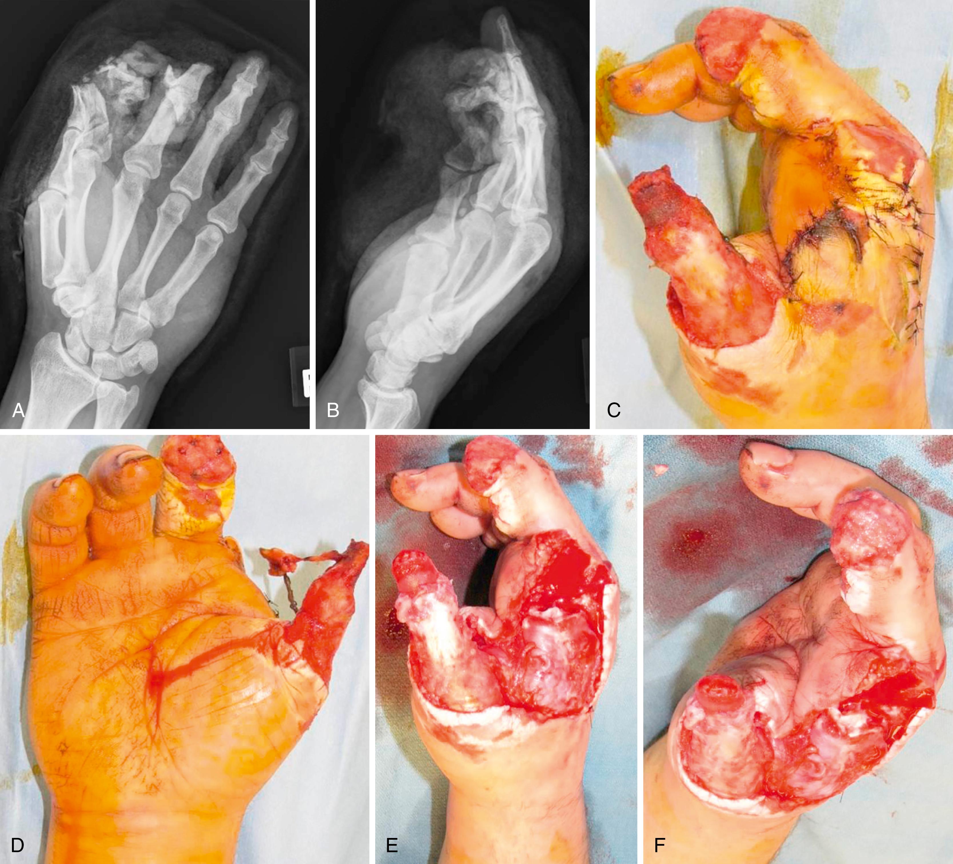 eFig. 43.3, Crush/avulsion injury to thumb, index, and middle finger. A and B, Radiographs. C and D, Clinical photos 48 hours after injury (with one debridement). E and F, Injury following second debridement.