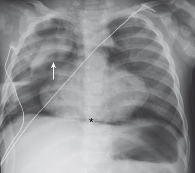 Figure 58.1, Pneumomediastinum in a 6-month-old boy.