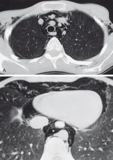 e-Figure 58.2, Pneumomediastinum in a 2-year-old girl.