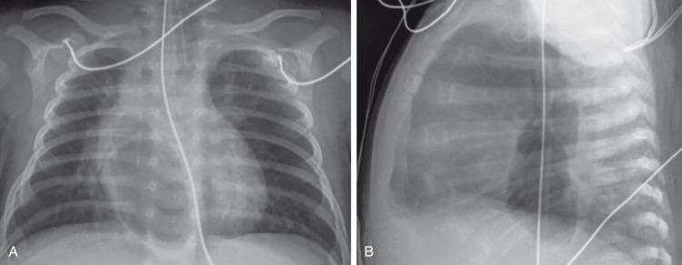 e-Figure 58.3, Infra-azygos pneumomediastinum in a 5-week-old after repair of an H-type tracheoesophageal fistula.