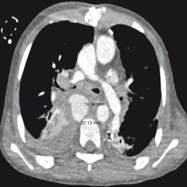 Figure 58.4, Mediastinal hemorrhage in a 7-year-old boy with congenital heart disease.