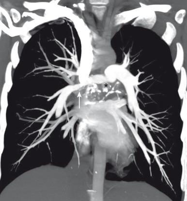 Figure 58.6, Chronic fibrosing mediastinitis in a 17-year-old girl.