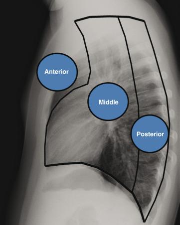 Figure 58.7, Anatomic landmarks demarcating the anterior, middle, and posterior compartments of the mediastinum on a lateral chest radiograph.