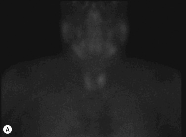 Fig. 4.3, Role of Scintigraphy in Detecting Parathyroid Adenomas.